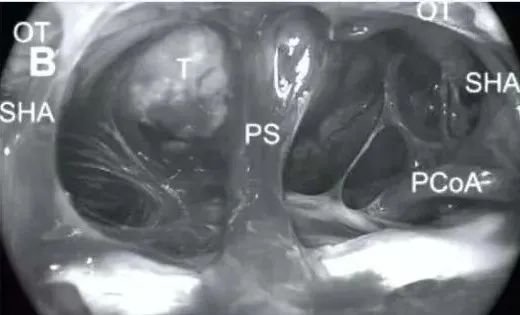 鞍膈上区暴露及结构识别