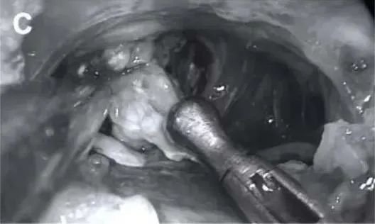 肿瘤切除，膜外钝性剥离