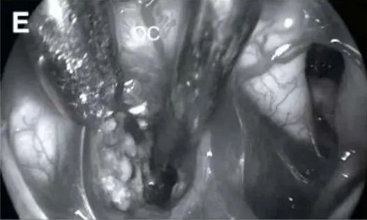 切换至30°内镜观察