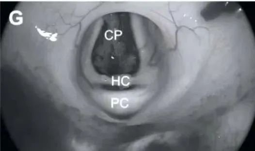 肿瘤完全切除后第三脑室背侧部分检查