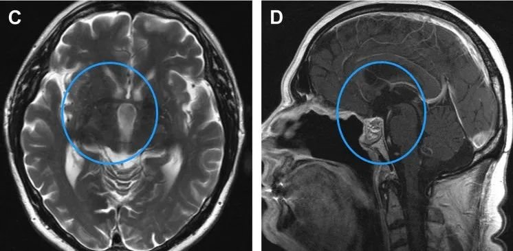 术后，Klaus曾经历短暂的意识模糊期，然而他的神志和认知功能迅速恢复，体重也保持稳定。术后两年内，未见肿瘤复发迹象。MRI检查结果显示，他的水肿已完全消退，且鼻中隔皮瓣成功重建了颅底。