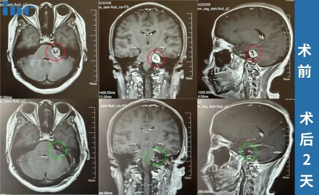 怕面瘫失聪？看巴教授成功为这名听神经瘤患者全切手术