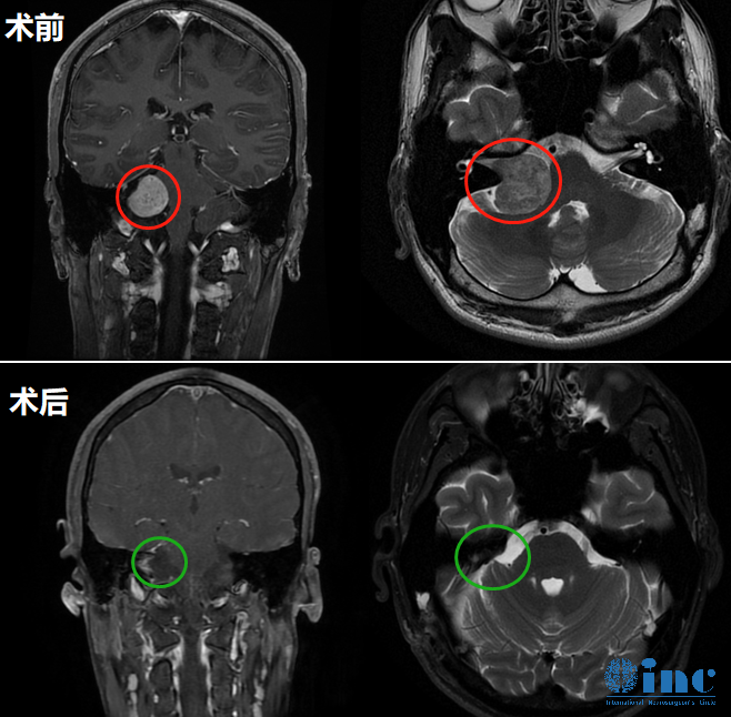大型听神经瘤如何做到全切肿瘤、面听神经解剖保留+功能保留？