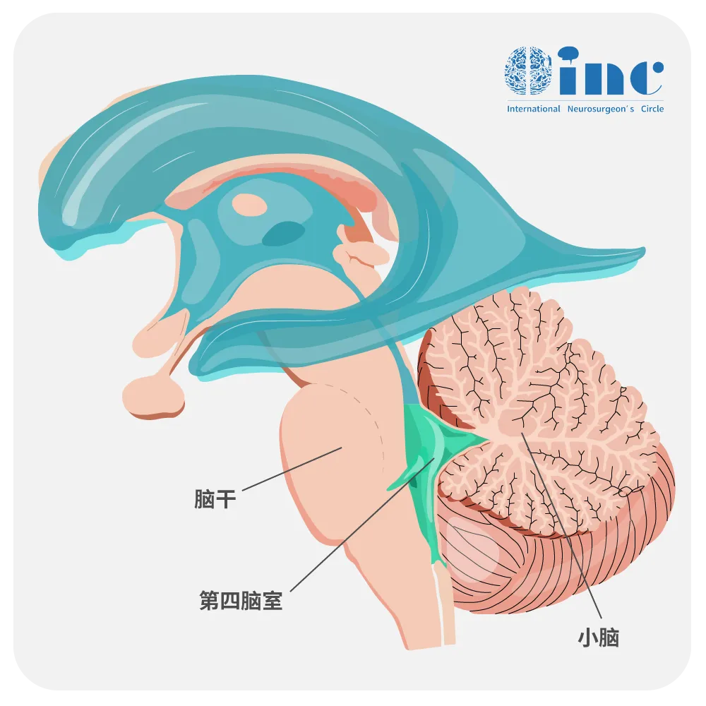 右侧海绵窦旁占位是什么意思
