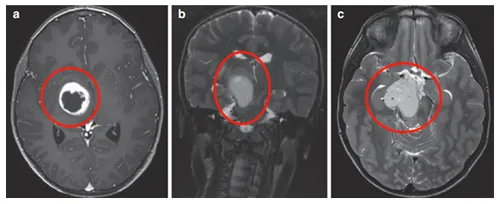 MRI显示右侧丘脑存在环形强化结节状肿瘤，累及内侧颞叶结构。