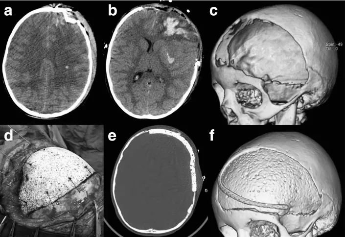 图 5：一名 6 岁女童遭受严重头部损伤（a），接受减压性颅骨切除术（b、c）。采用定制大孔羟基磷灰石（HA）进行颅骨修复（d - f）。