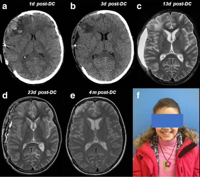 【INC国际大咖研究成果】儿童创伤性脑损伤后颅骨修补重建相关问题