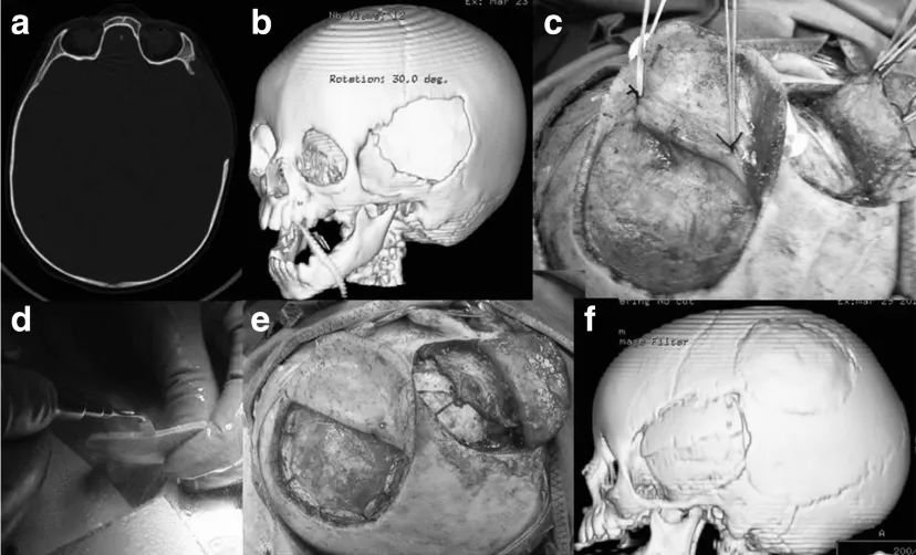 图 2：左侧颞部颅骨缺损，采用同侧顶区取下的自体移植骨修复（a - c），然后使用压电手术刀将其分割（d）。颅骨修复的术中照片及术后颅脑 CT 扫描图（e、f 分别为两者）。