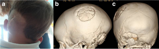 图 3：右侧枕下区缺损，采用同侧顶骨分割取下的自体移植骨修复（a），但因供区骨瓣次全吸收（b）以及枕下区假性脑脊液瘤形成导致移植骨吸收和移位而出现并发症（c）。
