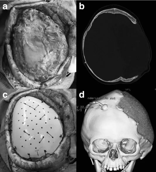 图 4：一名 11 个月大婴儿的大脑半球颅骨缺损(a 为术中照片，b 为术前 CT 扫描图)，采用定制的聚醚醚酮(PEEK)植入物进行修复(c 为术中照片，d 为术后三维 CT 扫描图)。