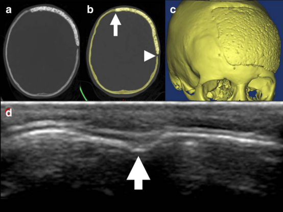 图6：早期术后 CT 扫描（a）与 1 年随访时的 CT 扫描（b、c）及超声检查（d）对比，证实骨组织已生长至植入物孔隙内（亨氏单位色彩分析显示，骨的亨氏单位以红色表示，并在植入物内凸显出来（b）），且植入物的内侧和颅侧边缘已实现骨整合（分别见 b、d 中的箭头），但后缘仍存在间隙（b 中的箭头）。