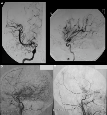 反复头痛千万别忽略，很有可能是大脑血管的“报警信号”！ | 烟雾病科普