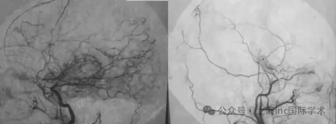 烟雾病血管造影影像