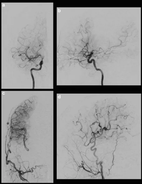 图3：春奈的术后右颈动脉造影显示经右侧大脑外动脉的旁路血流通过MCA和ACA供应到灌注较少的区域。右侧颈内动脉正位（a）、侧位（b）；右颈外动脉正位（c）、侧位（d）。
