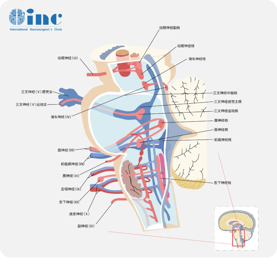 巴教授攻克脑干禁区肿瘤