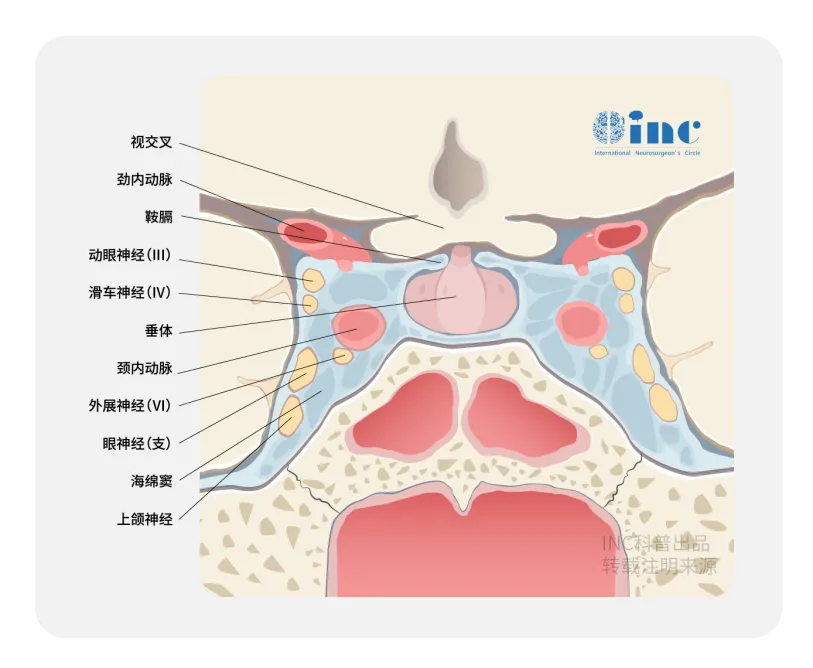 图示蓝色区域为海绵窦,海绵窦包围垂体复合体,包含颅神经(CNs) III、IV、V1、V2和VI,颈内动脉(ICA)的海绵段和颈动脉周围交感神经丛。颅神经III、IV和VI被蛛网膜鞘和蛛网膜颗粒包围,海绵窦内脑膜瘤由此产生。