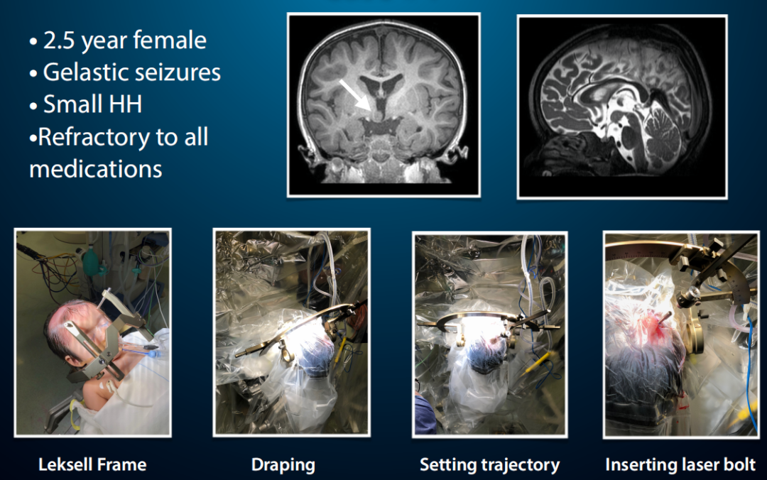 一名两岁半女童，被判定为难治性癫痫，Rutka教授对致痫灶进行了激光消融，消融过程仅需几分钟，术后随访显示她的预后良好，癫痫也未再发作。