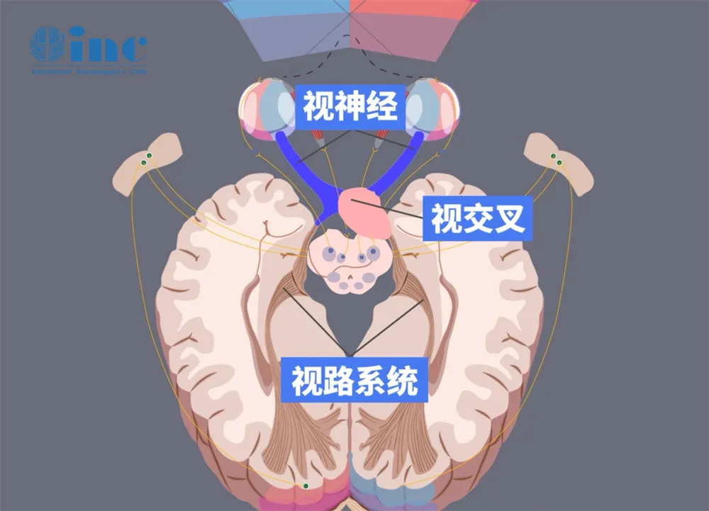 视路胶质瘤治疗