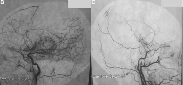儿童烟雾病有哪些症状？