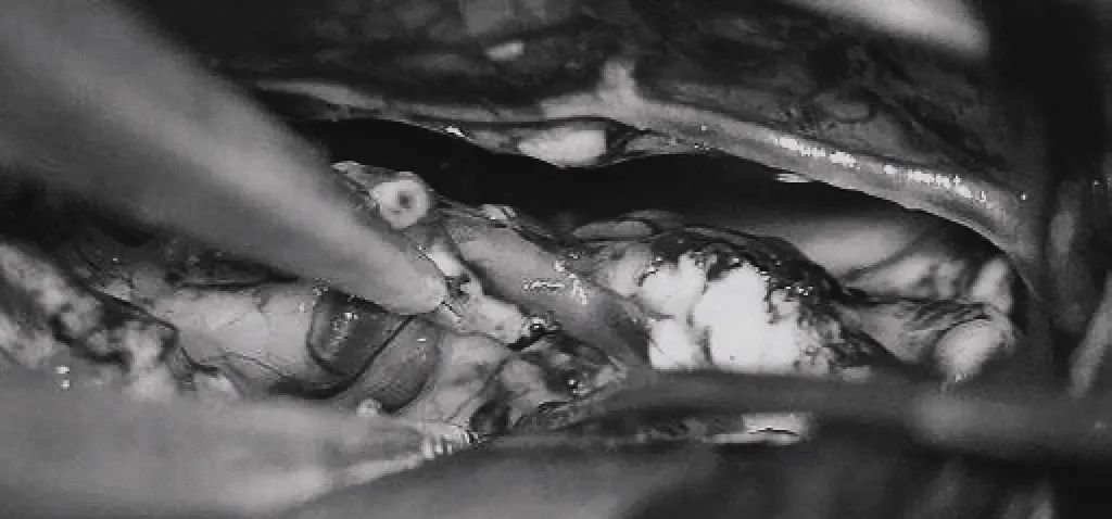 双额开颅，打开纵裂（鼻朝右，中线水平位，重力牵拉右侧半球），显露胼胝体、CmaA和PcaA。(d)切开胼胝体2.5cm，显露透明隔内的AVM，大致显露ACA。