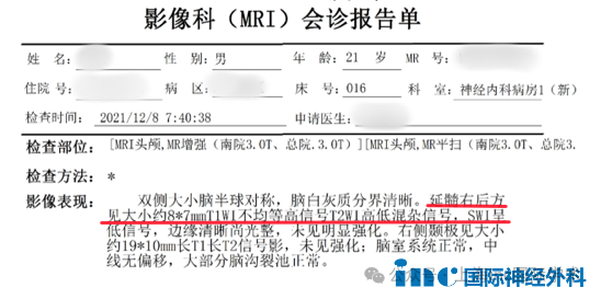 头部CT显示延髓后方近小脑见大小约6.8*9.9mm的片状高密度阴影，怀疑脑干海绵状血管瘤。
