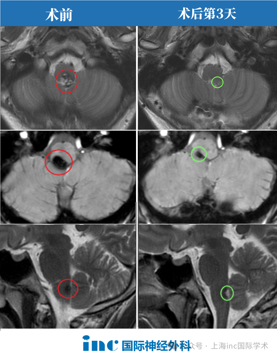 在国内手术团队的配合下，术中神经电生理监测下，巴教授全程主刀顺利全切了安豪的脑干海绵状血管瘤。