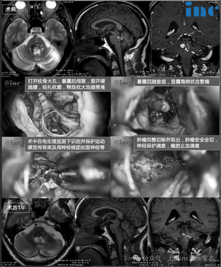 5月21日，60岁的王先生在苏州大学附属第四医院接受了由“巴教授”亲自主刀的脑干海绵状血管瘤切除术。