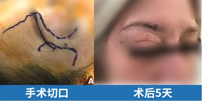 不开颅的脑瘤切除手术