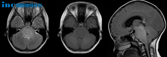 肿瘤恶化快,要先手术吗?