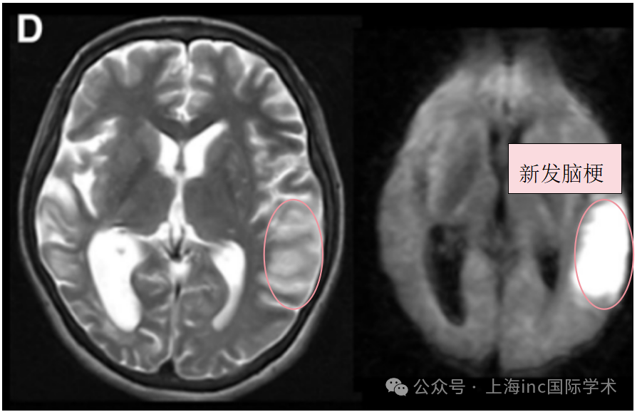 入院3天后术前T2、DWI序列显示左侧颞叶进一步新发脑梗死。