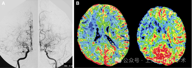 A，术前血管造影（双侧颈总动脉正视图）显示双侧颈内动脉末端部分狭窄伴烟雾病血管，以及双侧大脑中动脉（MCA）狭窄。B，术前Xe-CT显示右侧MCA区域脑血流量减少（27.2 ml/100 g/min）（左），以及右侧 MCA 区域脑血管反应性受损（10.7%）（右）。