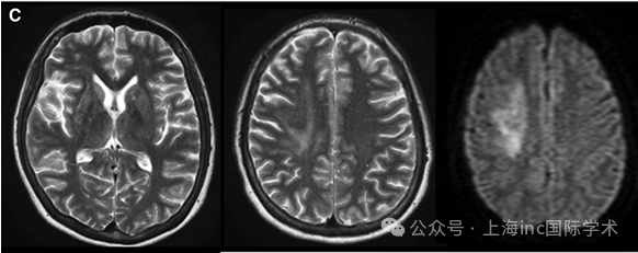 C，术前 T2 加权磁共振图像(左和中)和弥散加权图像(右)显示右侧放射冠状动脉脑梗死。