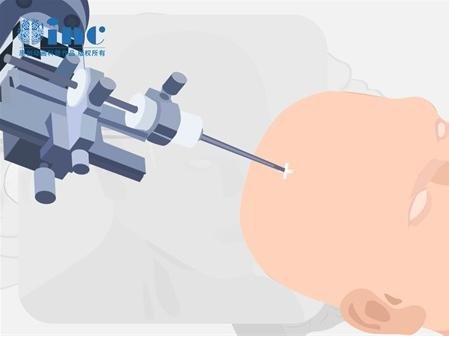 斜坡占位跟血糖有关系吗