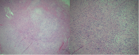 苏木精- 伊红染色的组织学标本显示细胞区域含栅栏状排列的细胞核（安托尼 A 型），交替出现少细胞区域由疏松水肿间质中不规则排列的细胞构成（安托尼 B 型）。