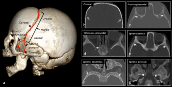 图2：冠状弓(a)起始于前囟;由冠状缝(白色箭头，b)组成，每个冠状缝分为前支和后支。前支由额蝶缝(白色箭头，c)和筛蝶软骨联合(白色箭头，d)构成;后支由蝶顶缝(白色箭头，e)、蝶颞缝(白色箭头，f)和蝶岩软骨联合(白色箭头，g)构成。