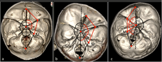 图 4：对患有先天性斜头畸形的婴儿进行了颅底形态测量分析，根据颅底畸形的严重程度将这些婴儿分为三个亚组：IIa 组、IIb 组和 III 组。研究使用 3D-CT 图像(图 a、b、c 分别对应 IIa 组、IIb 组和 III 组)进行分析。