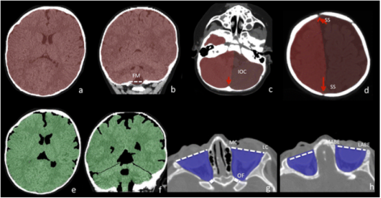 图 5：颅内腔和眼眶的体积分析。颅内体积（ICV）：用红色阴影区域表示（图 a 和 b）。ICV 包括从枕骨大孔到颅顶的整个颅内腔。图中勾勒出颅骨内板与脑表面的界面。