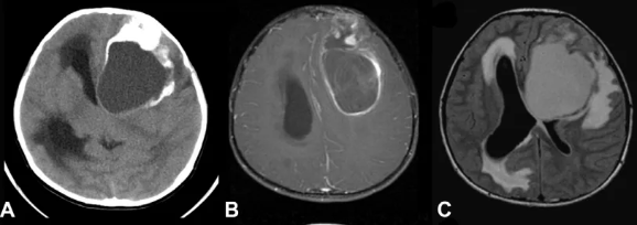 巨大室管膜瘤抢占1/4大脑！这样治疗后，孩子5年生存率竟高3倍？