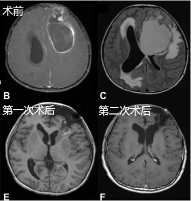 INC国际儿童脑瘤手术大咖James T. Rutka教授James T. Rutka教授在研究中称，手术切除的范围已被确定为影响预后的主要因素，有证据表明，大多数复发发生在原发肿瘤的部位，且在未完全切除患儿中的复发率较高。