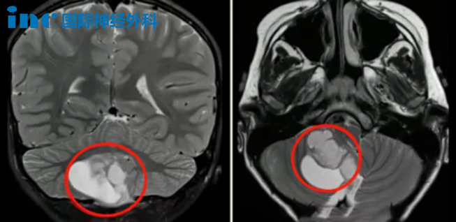反而查出了“小脑占位”，疑似毛细胞型星形细胞瘤。
