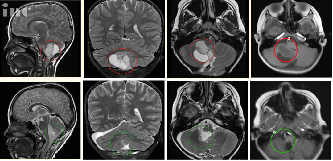术后病理结果为毛细胞型星形细胞瘤，WHO 1级，这代表着只要全切，辰辰的预后将很好，甚至有望达到长期生存的治愈性结局。