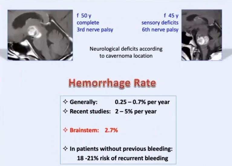 脑干部位出血概率偏高，达每年2.7%。再次出血率则可高达18%-21%。而且每出血一次，再次出血间隔缩短；每出血一次，患者症状呈进行性加重，而神经系统症状能够恢复的可能性越小。