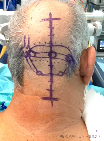 图：术中行幕下小脑上入路