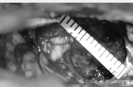 图：肿瘤全切，入脑干切除病变的切口仅有1.1CM