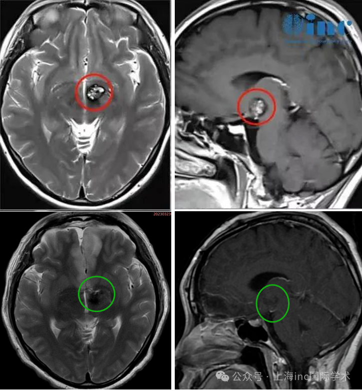 文文全切丘脑海绵状血管瘤