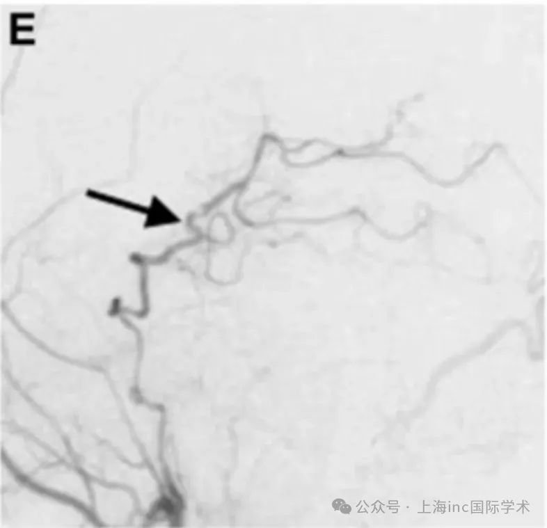 同时，选择 PTA 作为受体动脉，因为其口径和角度优于 P3 段进行吻合。进行 STA-PTA 旁路手术后，川岛教授将远端夹子放置在夹层动脉瘤上，同时保留穿支。