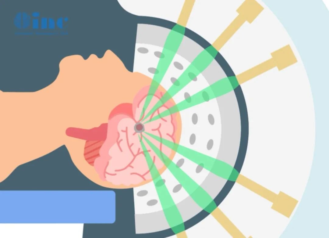 放疗：可提高患儿生存率