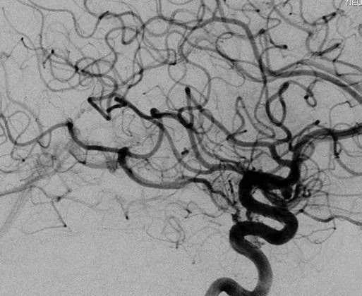 颞叶内侧少量残留畸形团向BVR引流(右ICA造影，侧位)
