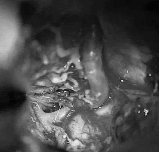 显露PCA周围至其ParOccA和CalcA(P2P)分叉