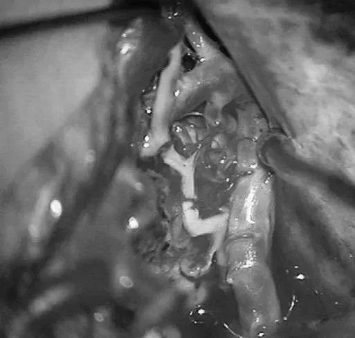 沿小脑幕见PCA的大脑脚段(P2A)和硬化的供血支。